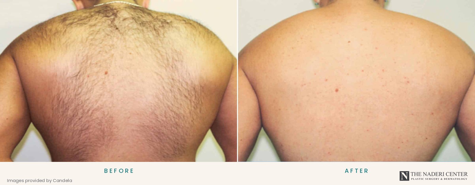 Before and after laser hair removal on the upper back, images provided by Candela