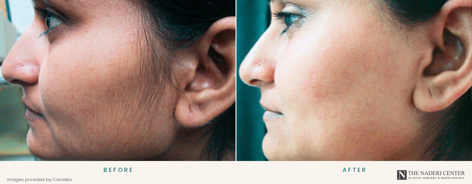 Before and after laser hair removal on the side of the face, images provided by Candela