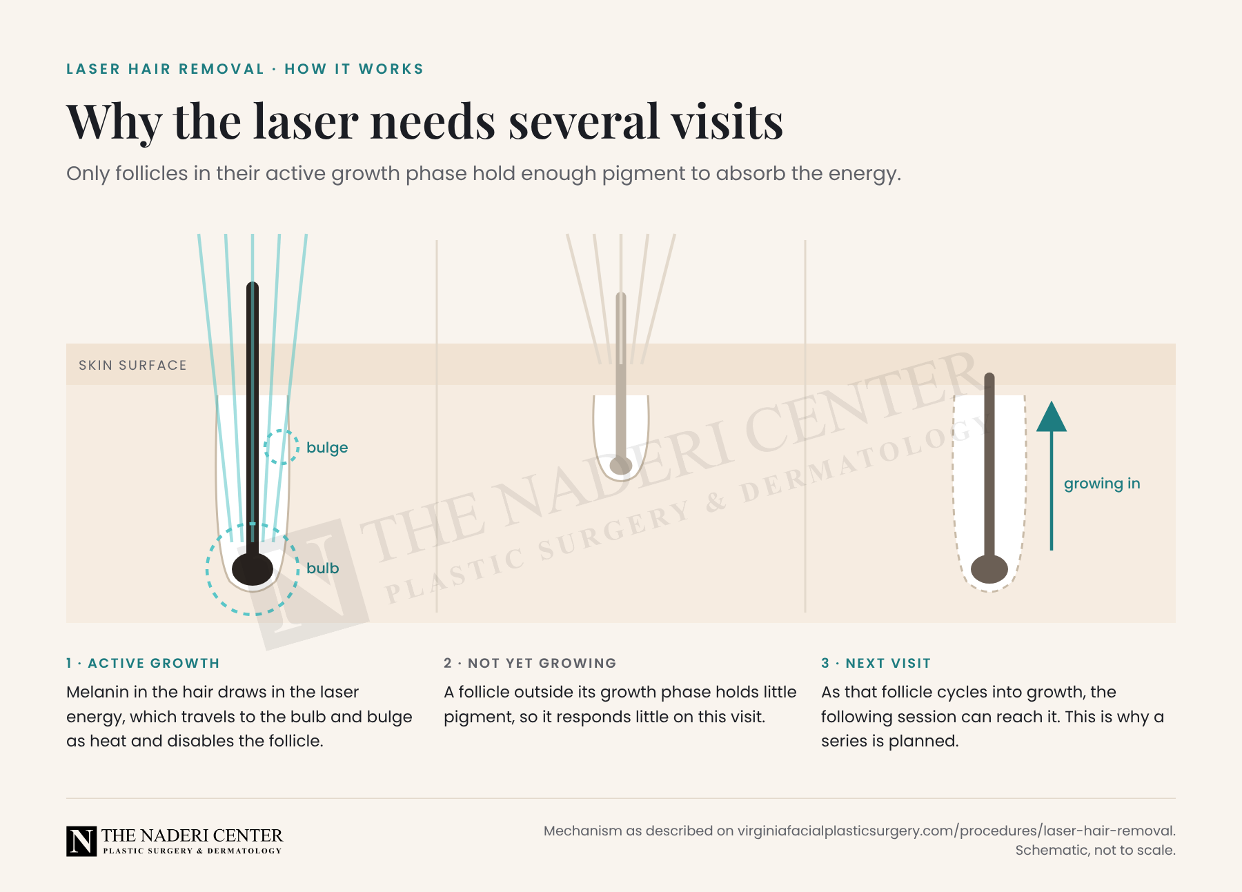Diagram of hair follicles showing why laser hair removal reaches follicles in the active growth phase and needs several sessions