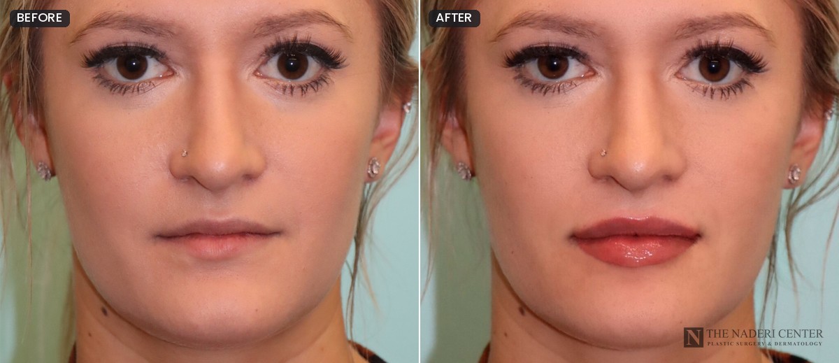 Before and after lip augmentation with 1 cc of Juvederm Ultra, front view