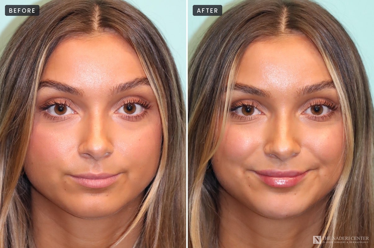 Before and after lip filler with Restylane Kysse, front view, The Naderi Center