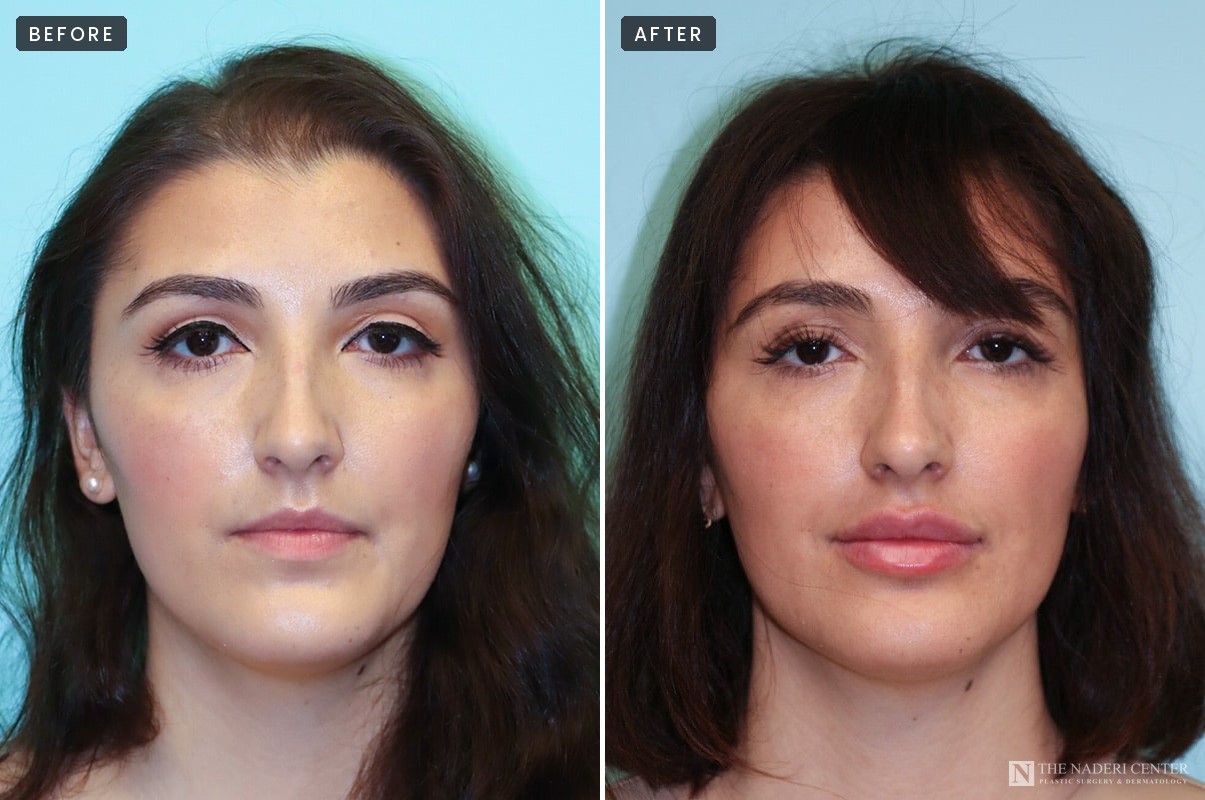 Before and after lip filler, front view, The Naderi Center