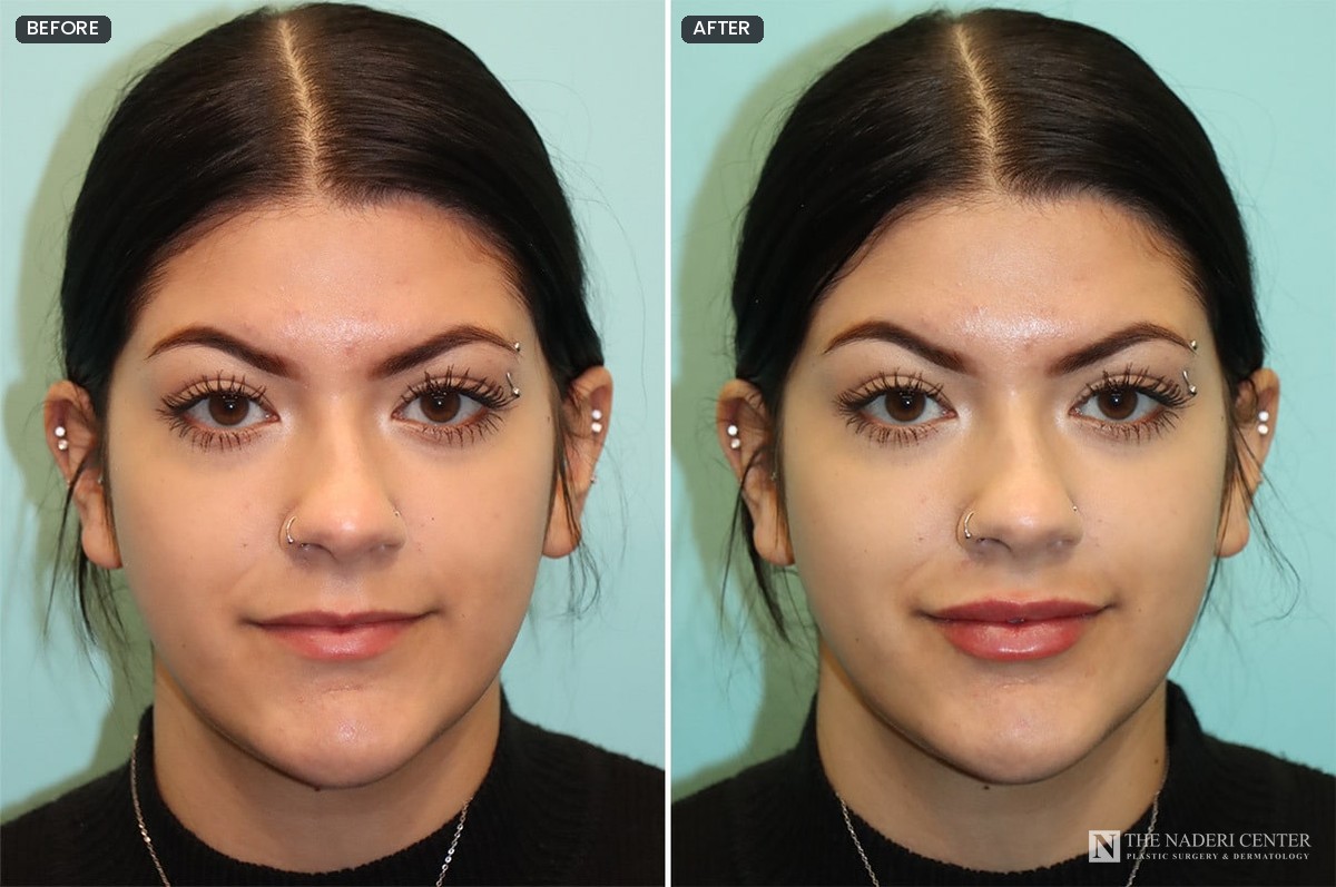 Before and after lip filler with one syringe of Juvederm Ultra for volume and symmetry, front view