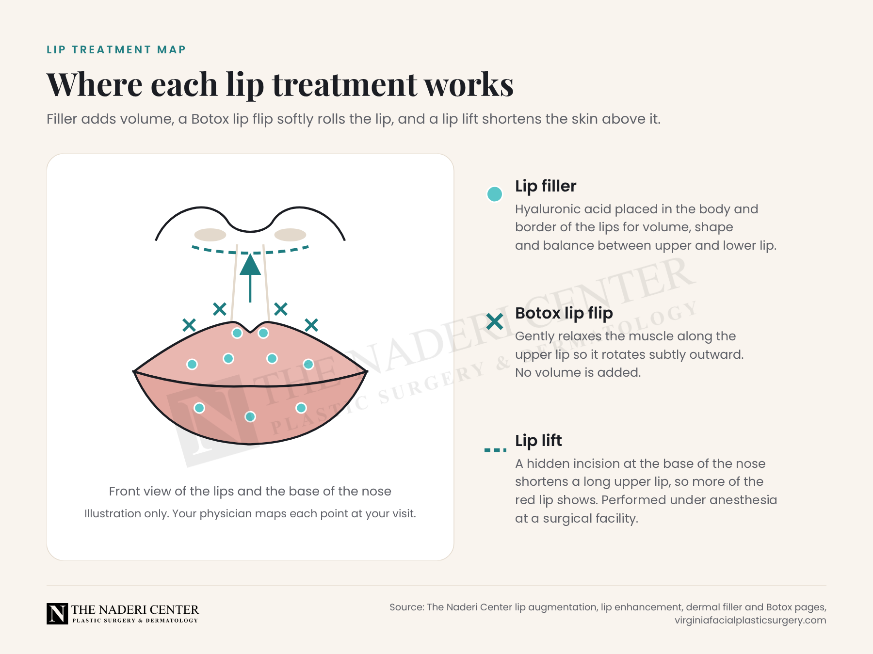 Diagram of the lips and base of the nose showing where lip filler is placed, where a Botox lip flip relaxes the upper lip and where a subnasal lip lift incision sits