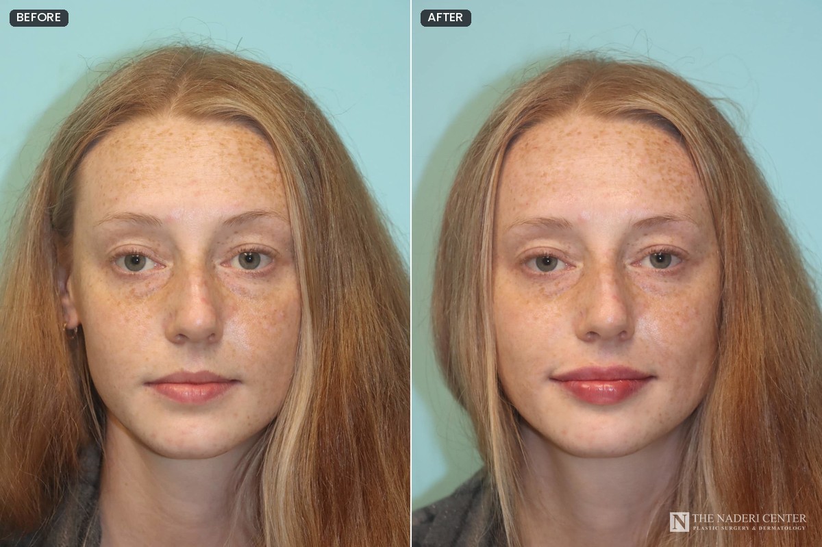 Before and after first-time lip filler with one syringe of Restylane Kysse, front view