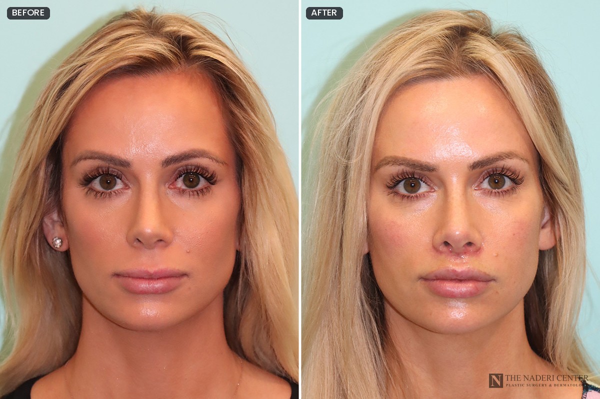 Before and after upper lip lift for more lip projection without filler, front view, about one month after surgery