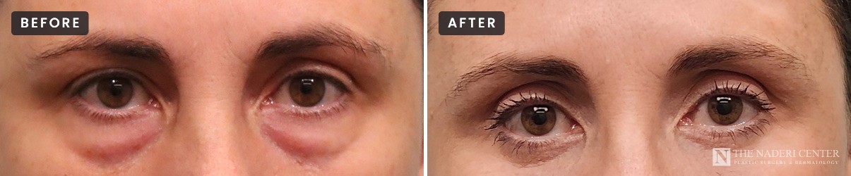 Lower eyelid surgery before and after: close-up of under-eye bags before lower blepharoplasty (left) and smoother lower lids after (right), The Naderi Center