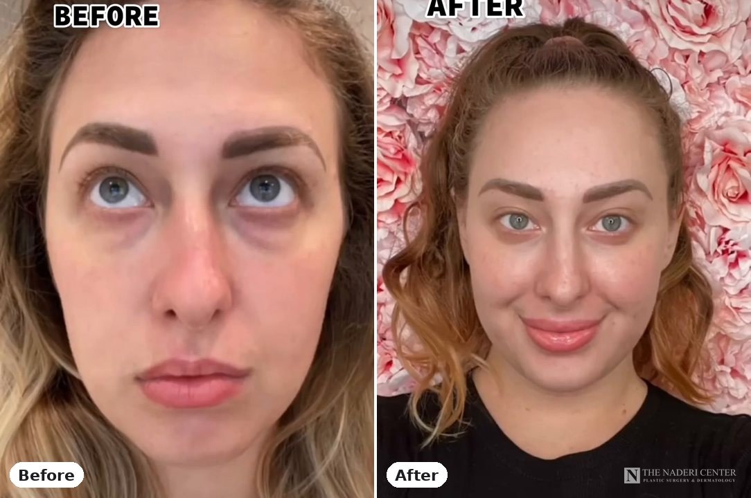 Lower eyelid surgery before and after, real patient at The Naderi Center in Reston, VA and Chevy Chase, MD