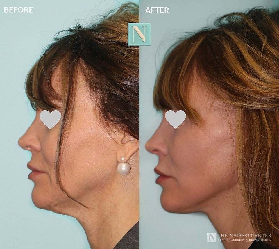 Lower facelift, neck lift and CO2 laser before and after, real patient at The Naderi Center in Reston, VA and Chevy Chase, MD