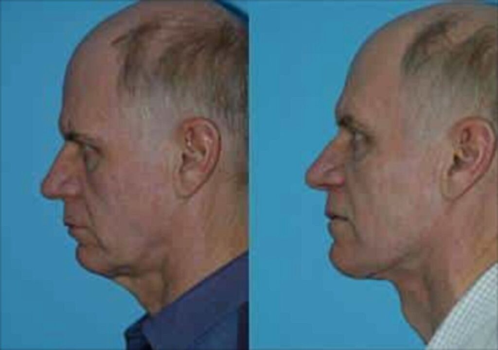 Male neck lift before and after photo, profile view, The Naderi Center