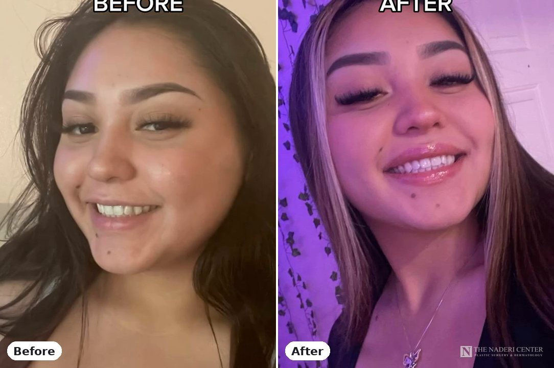Masseter Botox and lip flip before and after, real patient at The Naderi Center in Reston, VA and Chevy Chase, MD