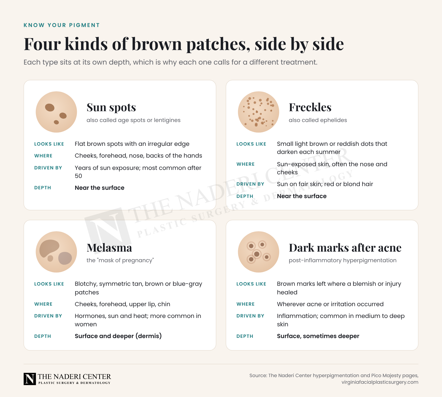 Chart comparing sun spots, freckles, melasma and dark marks after acne by appearance, location, cause and depth in the skin