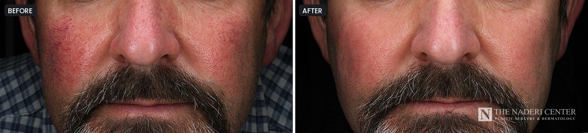 Man's cheeks before and after a series of four BBL treatments, The Naderi Center