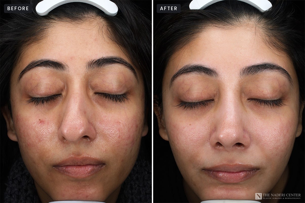 Microneedling with PRP before and after, front view, acne marks and texture, patient of The Naderi Center