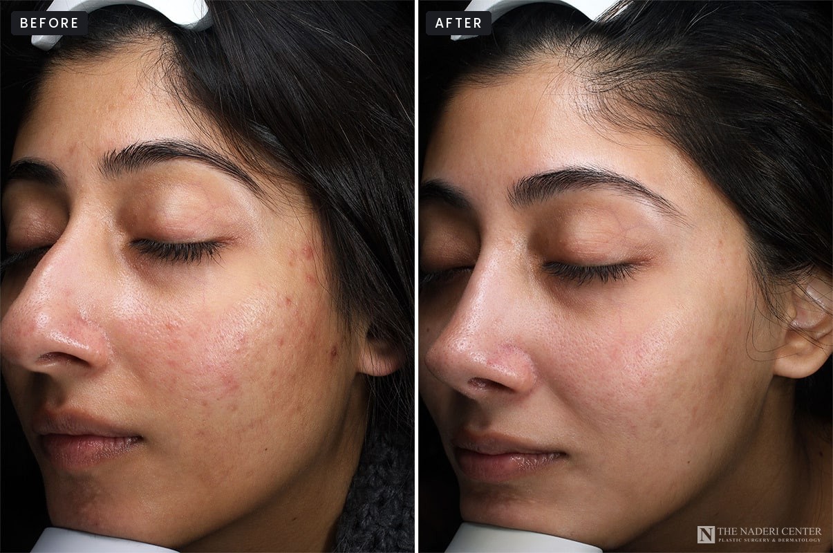 Microneedling with PRP before and after, left side view, acne marks and texture, patient of The Naderi Center