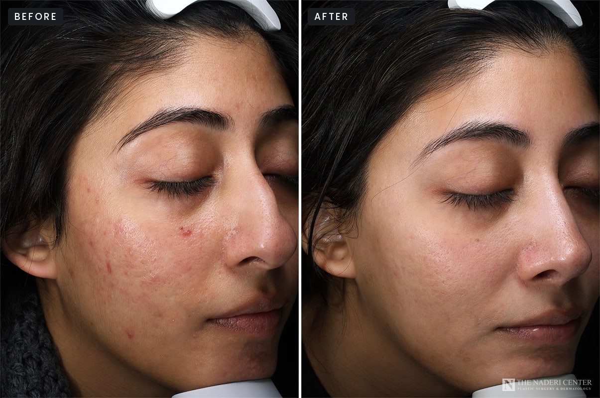 Microneedling with PRP before and after, right side view, acne marks and texture, patient of The Naderi Center