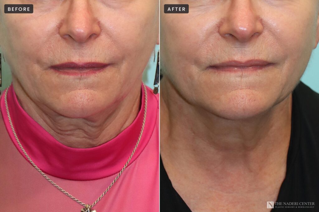 Morpheus8 before and after: lower face and neck before treatment (left) and after two sessions (right), The Naderi Center