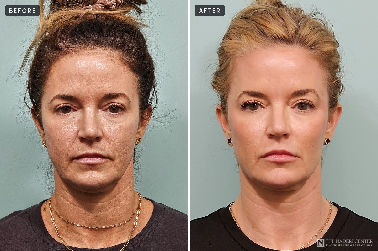 Morpheus8 before and after: front view of the face and neck before treatment (left) and after (right), The Naderi Center