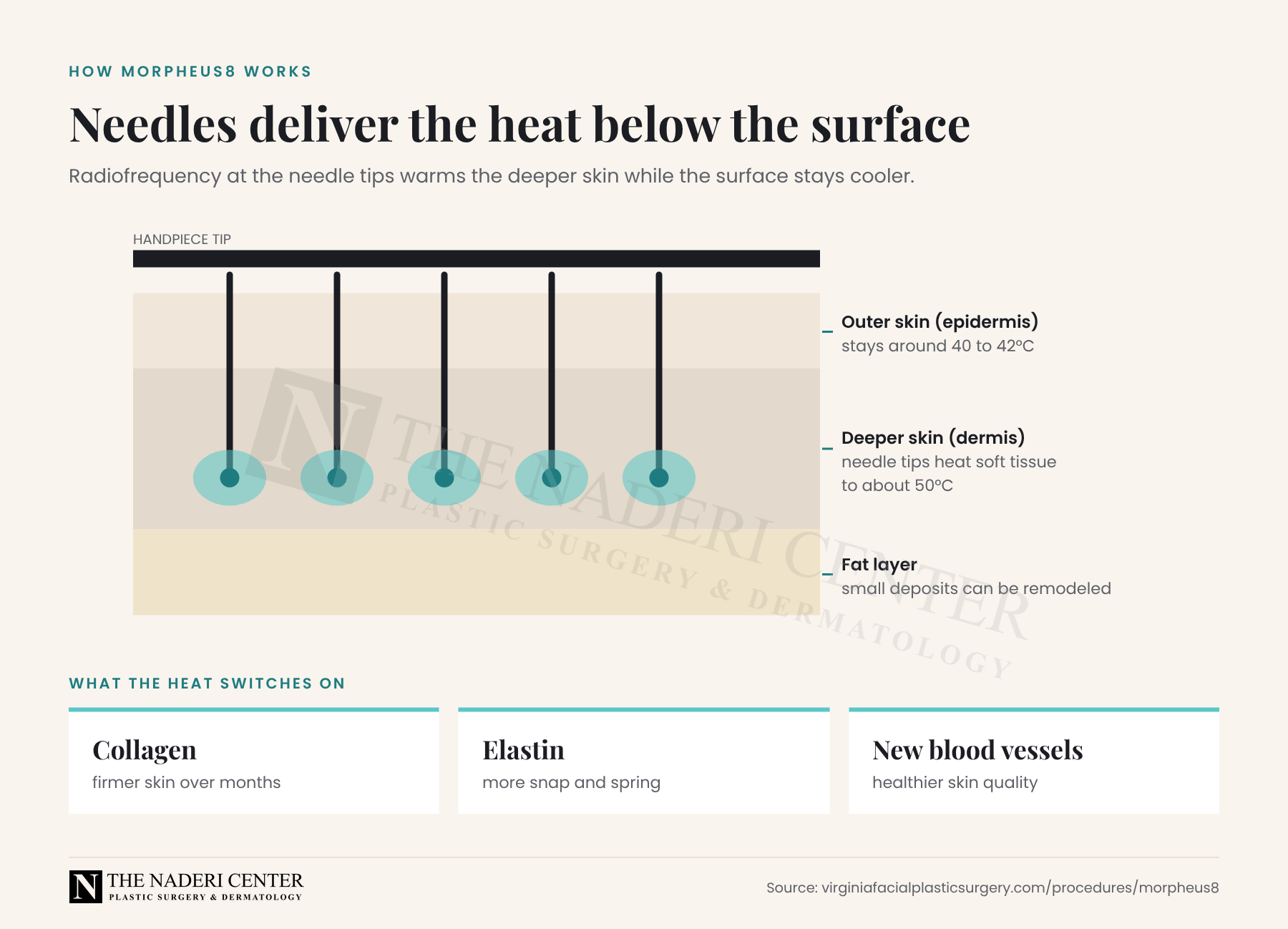 Diagram of Morpheus8 needles heating the dermis to about 50°C while the outer skin stays around 40 to 42°C