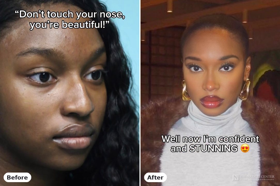 Rhinoplasty before and after photos shared by a patient of The Naderi Center