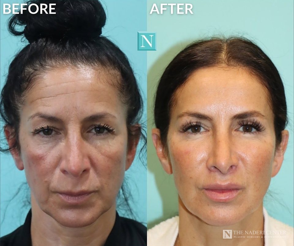 Eyelid surgery, lip lift, Botox and filler before and after photos shared by a patient of The Naderi Center