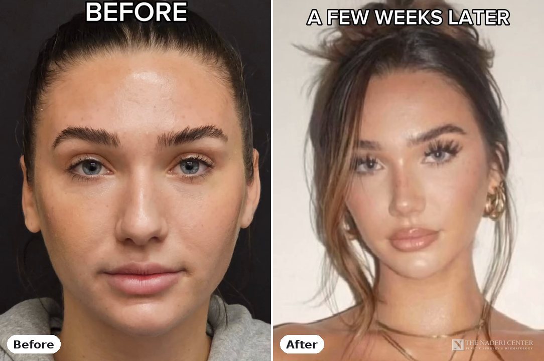 Rhinoplasty before and after photos shared by a patient of The Naderi Center