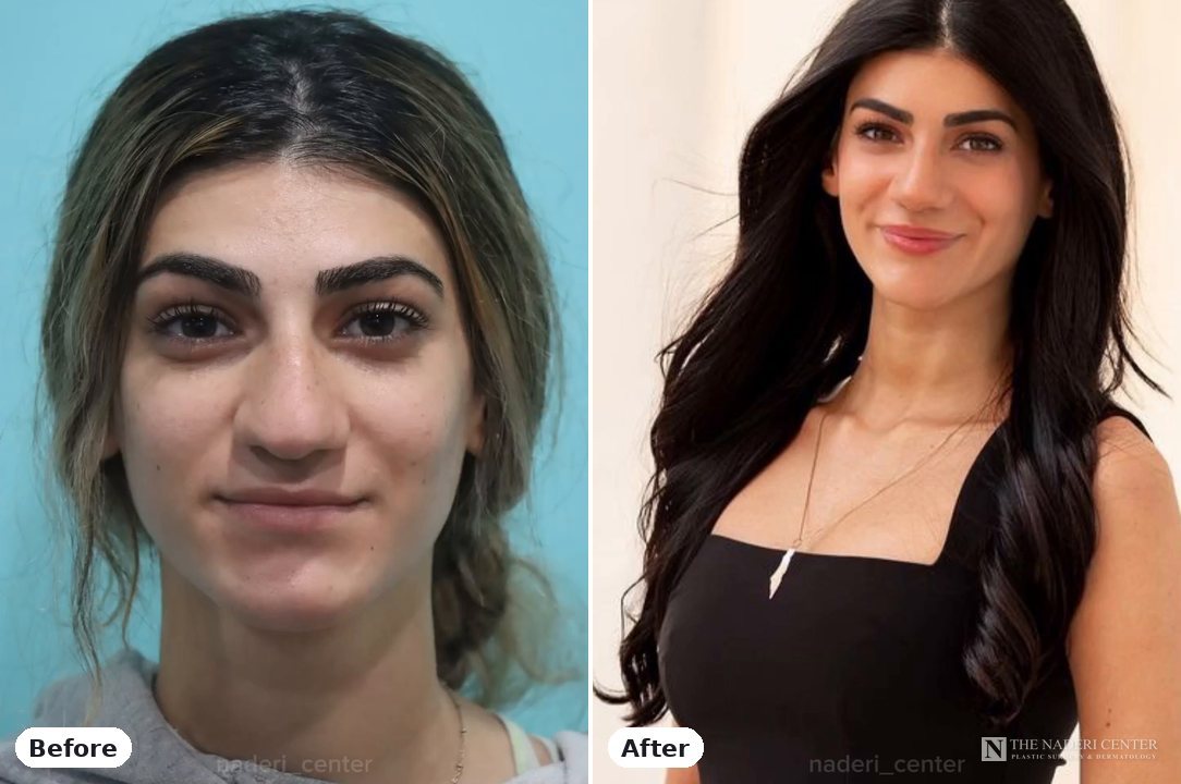 Rhinoplasty before and after photos shared by a patient of The Naderi Center