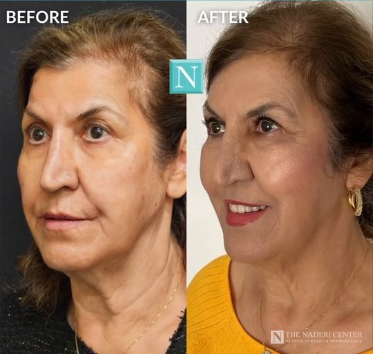 Filler and Daxxify before and after photos shared by a patient of The Naderi Center