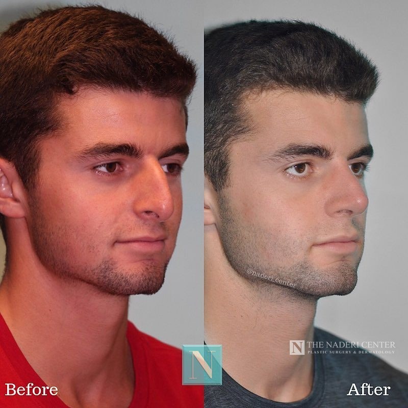 Rhinoplasty before and after photos shared by a patient of The Naderi Center