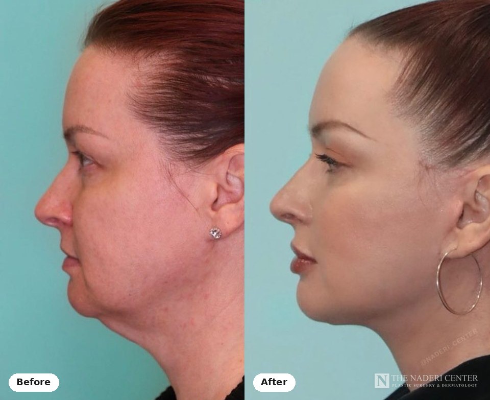 Lower eyelid surgery and lower face and neck lift before and after photos shared by a patient of The Naderi Center