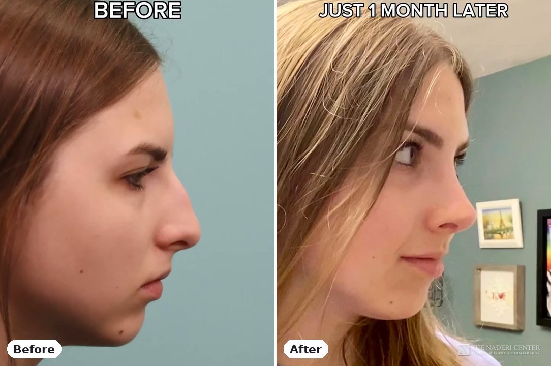 Rhinoplasty before and after photos shared by a patient of The Naderi Center