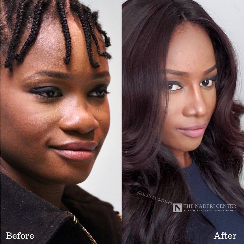 African American rhinoplasty before and after photos shared by a patient of The Naderi Center