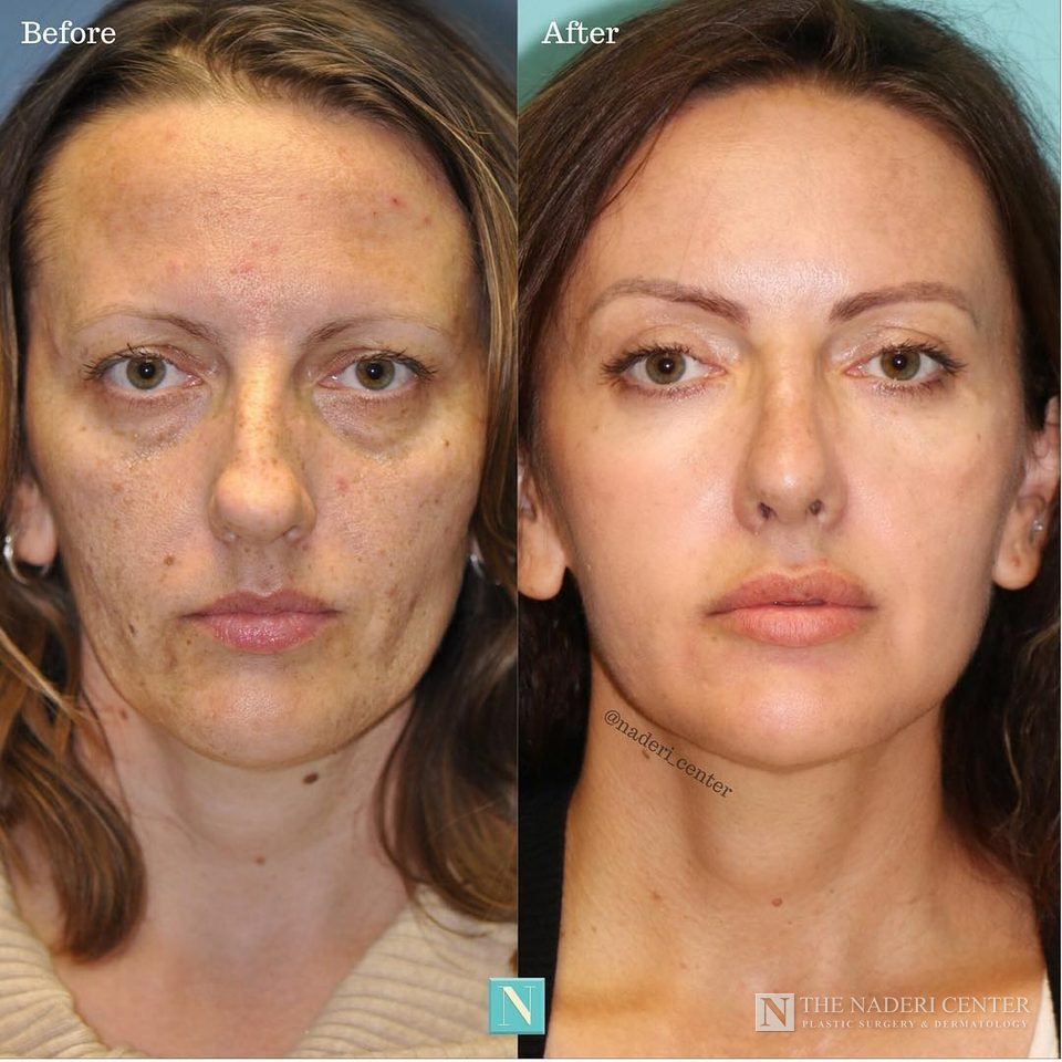 Rhinoplasty, eyelid surgery, fat transfer and CO2 laser before and after photos shared by a patient of The Naderi Center