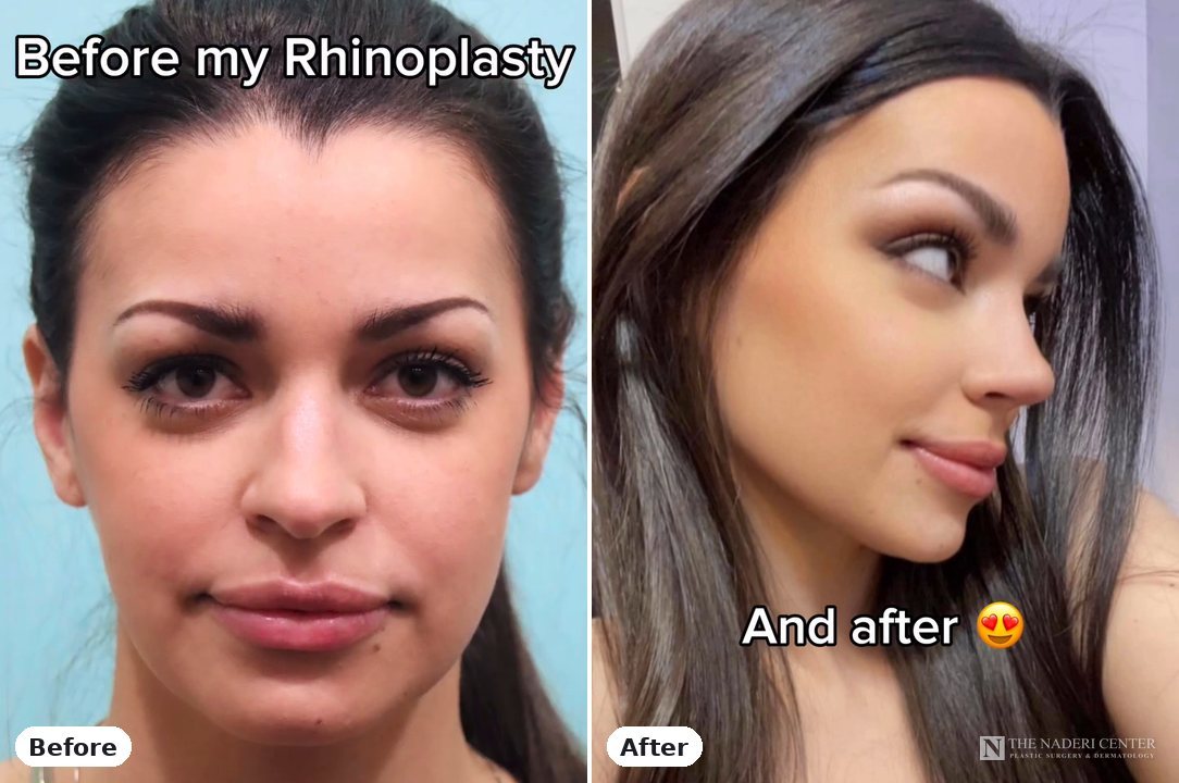 Rhinoplasty before and after photos shared by a patient of The Naderi Center