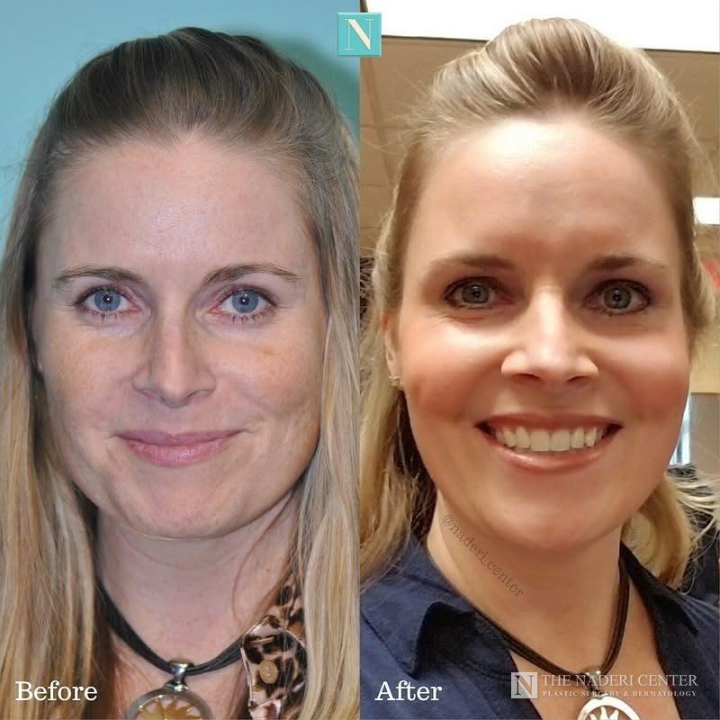 Laser resurfacing before and after photos shared by a patient of The Naderi Center
