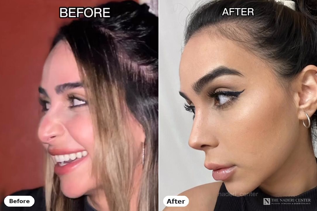 Rhinoplasty before and after photos shared by a patient of The Naderi Center