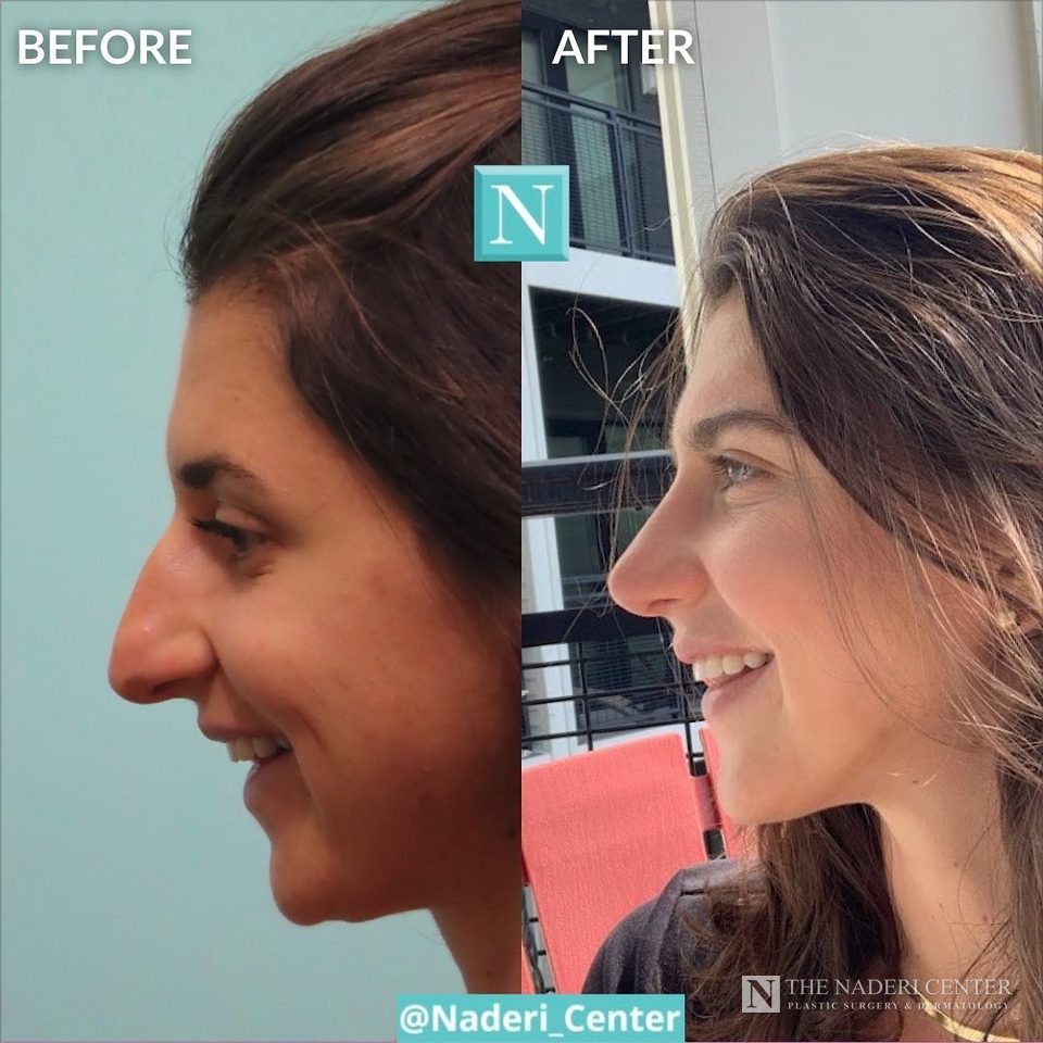 Rhinoplasty before and after photos shared by a patient of The Naderi Center