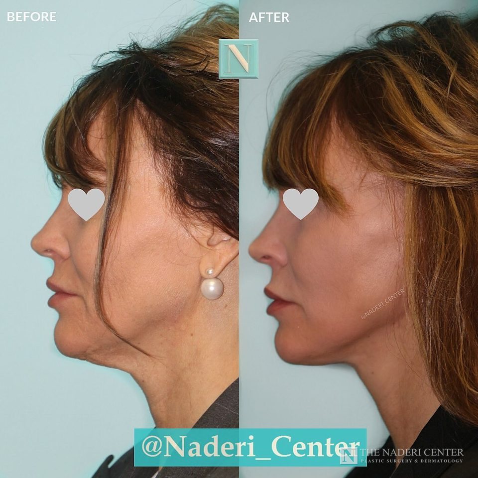 Lower facelift, neck lift and CO2 laser before and after photos shared by a patient of The Naderi Center