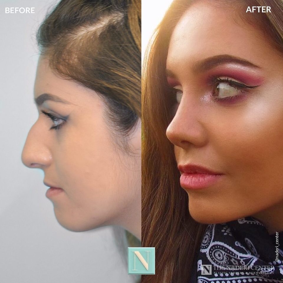 Rhinoplasty before and after photos shared by a patient of The Naderi Center