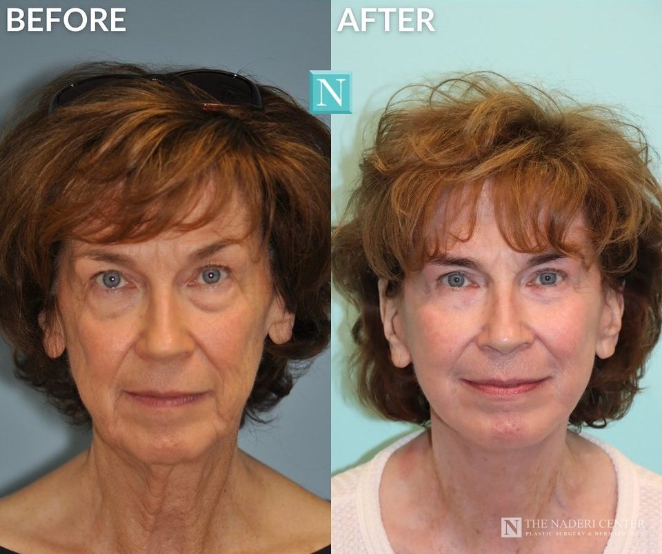 Facelift, neck lift, eyelid surgery and CO2 laser before and after photos shared by a patient of The Naderi Center