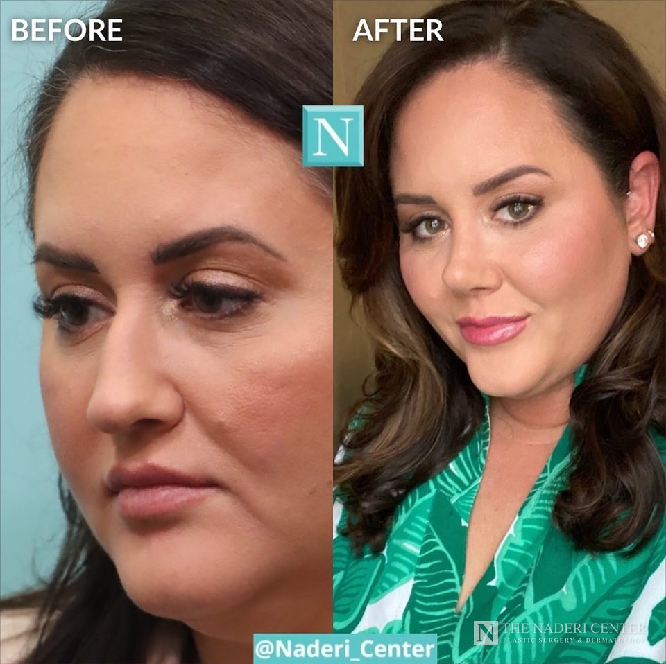 Rhinoplasty before and after photos shared by a patient of The Naderi Center