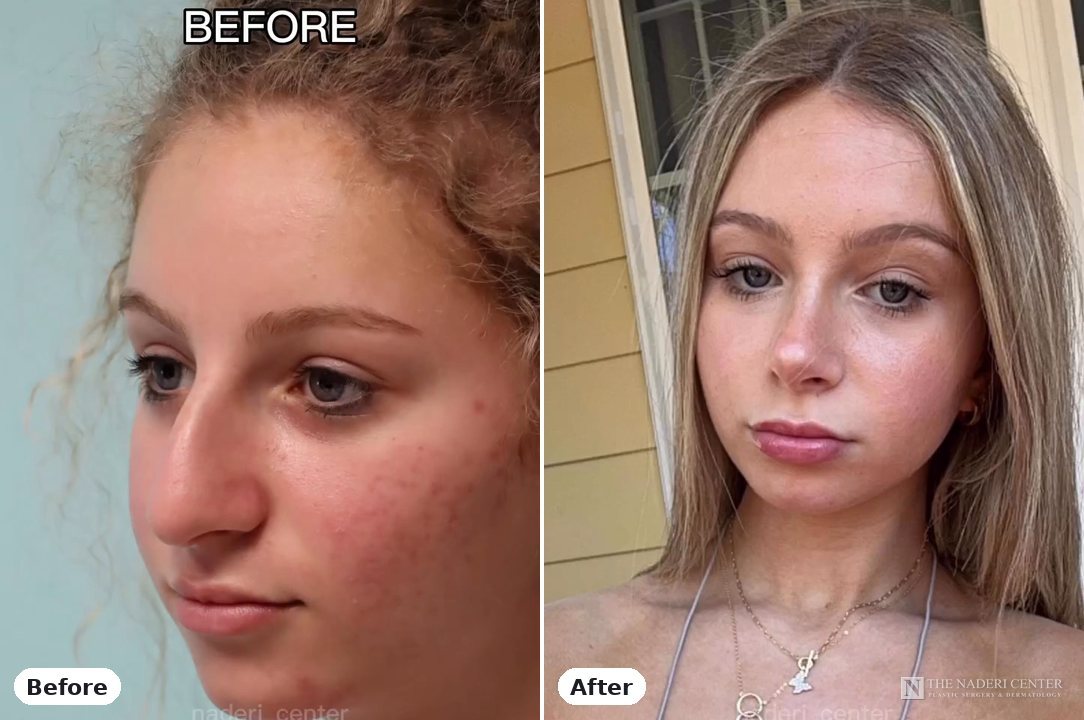 Rhinoplasty before and after photos shared by a patient of The Naderi Center