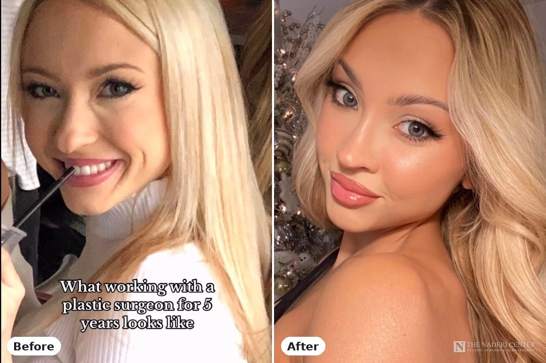 Rhinoplasty, injectables and skincare before and after photos shared by a patient of The Naderi Center