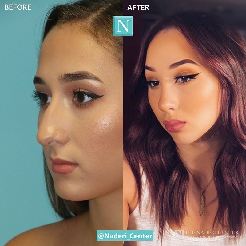 Rhinoplasty before and after photos shared by a patient of The Naderi Center