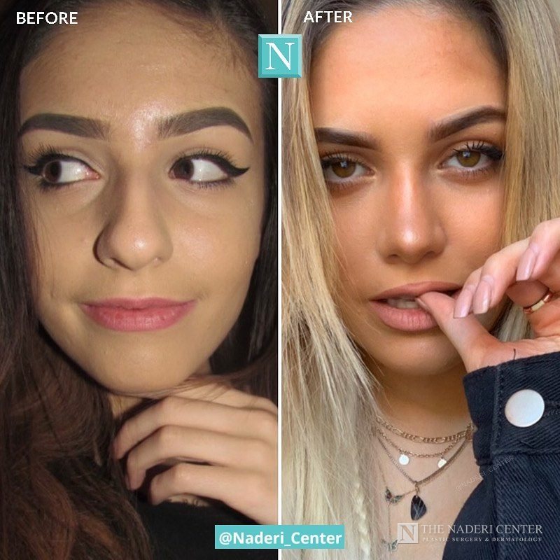 Rhinoplasty before and after photos shared by a patient of The Naderi Center