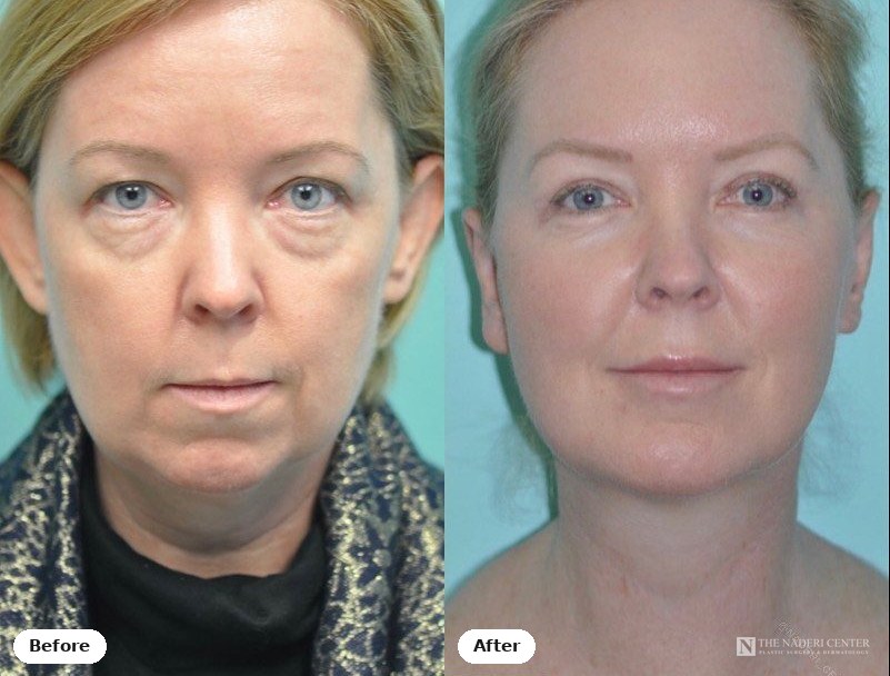 Facial rejuvenation before and after photos shared by a patient of The Naderi Center