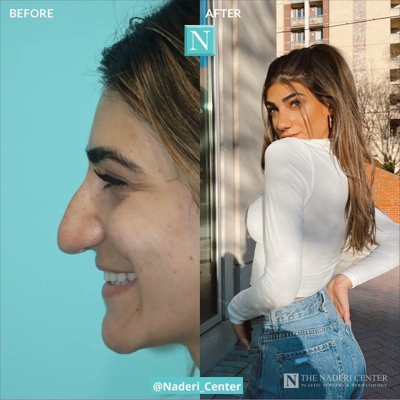 Rhinoplasty before and after photos shared by a patient of The Naderi Center