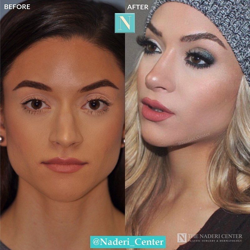 Rhinoplasty before and after photos shared by a patient of The Naderi Center