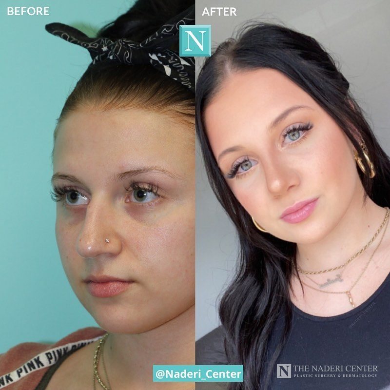Rhinoplasty before and after photos shared by a patient of The Naderi Center