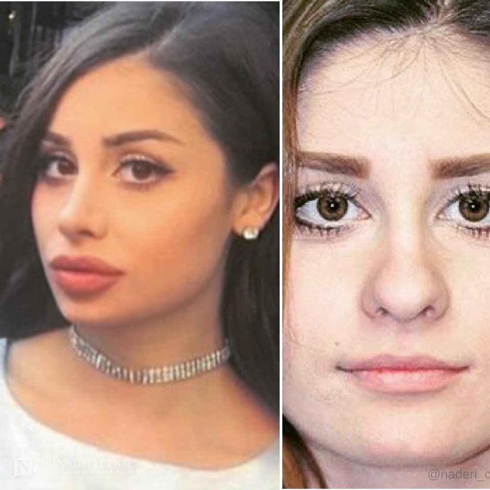 Rhinoplasty and lip filler before and after photos shared by a patient of The Naderi Center